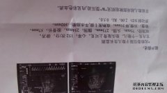 如果胎儿颈部出现uw型凹陷，该怎么办？