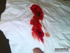 他手术了吗？如果不做手术，可以根治痤疮吗？