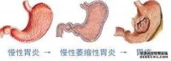 有胃病的人如何预防胃癌？