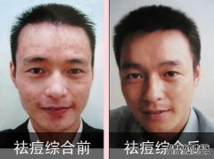 一个25岁的男人的脸上两头都有粉刺。