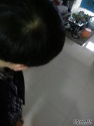 婴儿脱发是否缺乏钙？