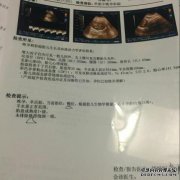 今天，在怀孕32周的时候，我去医院检查了B单身