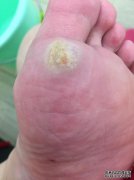 [？在脚底上使用的药膏类型]