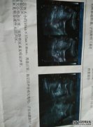 子宫内膜厚度3毫米会怀孕吗？