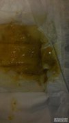 引起黄色和臭便的腹泻的原因是什么？