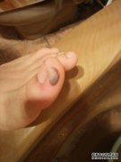 如果我的脚上有青肿怎么办？