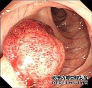 尿道肉是什么意思？